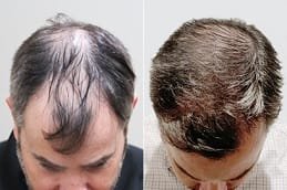 fue-hair-transplant-in-abu-dhabi-1