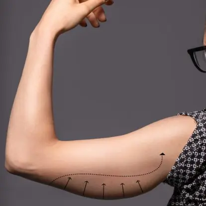 lipo after arm